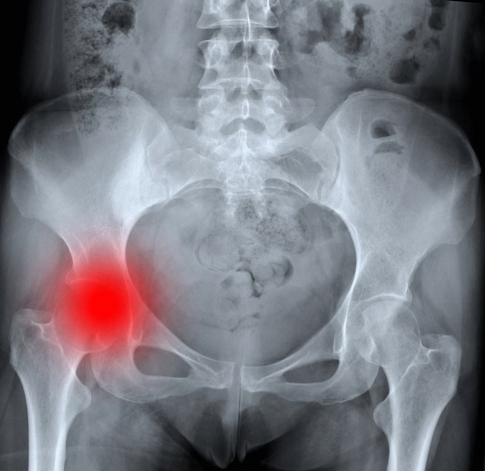 Hip-Dislocation-with-Fractures-of-the-Acetabulum