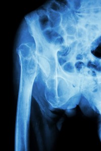 Isolated-Traumatic-Hip-Dislocations--Acute-Issue,-Long-Term-Problem