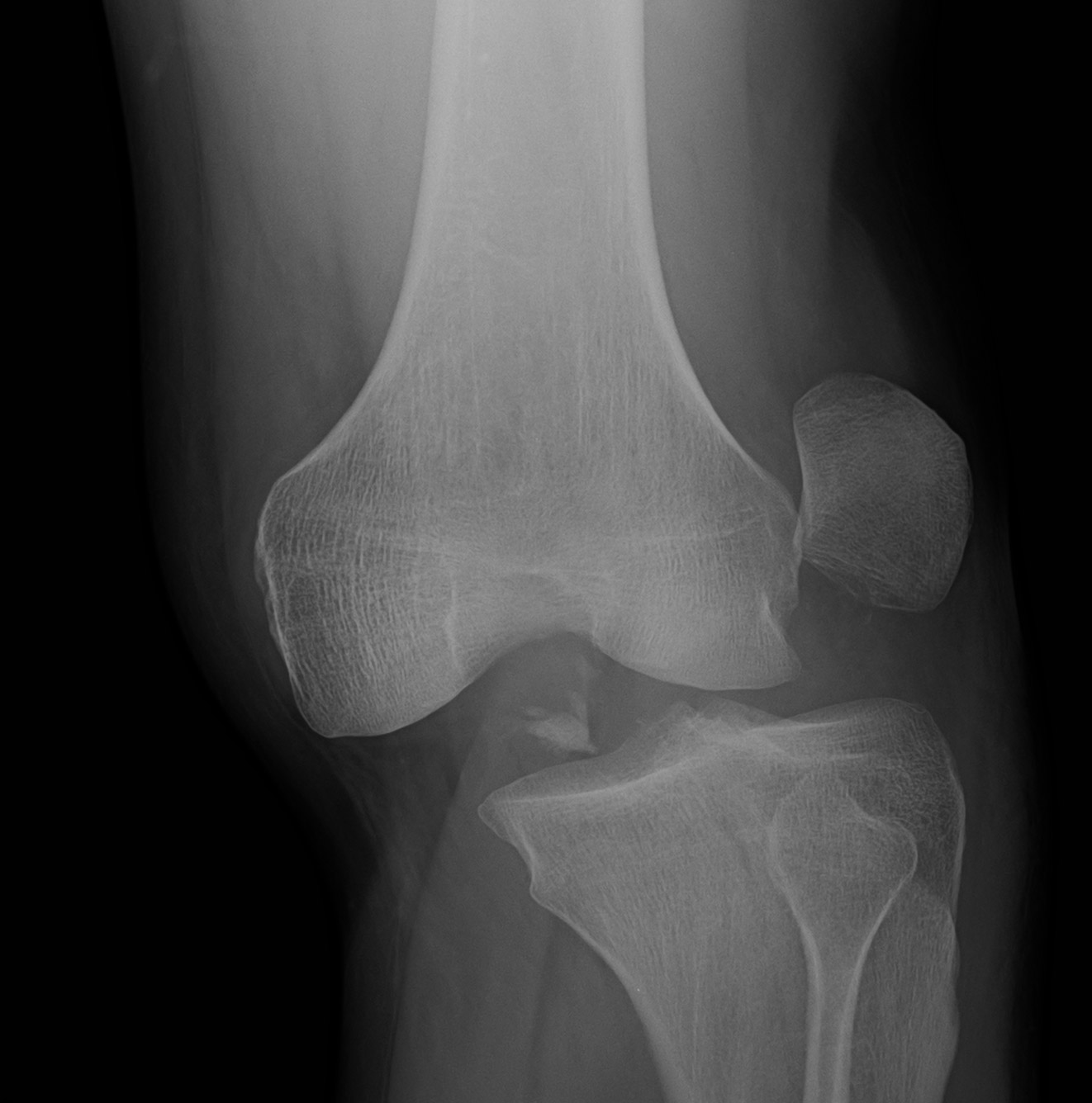 Dislocation-of-the-Knee-Diverse-Injuries,-Diverse-Outcomes